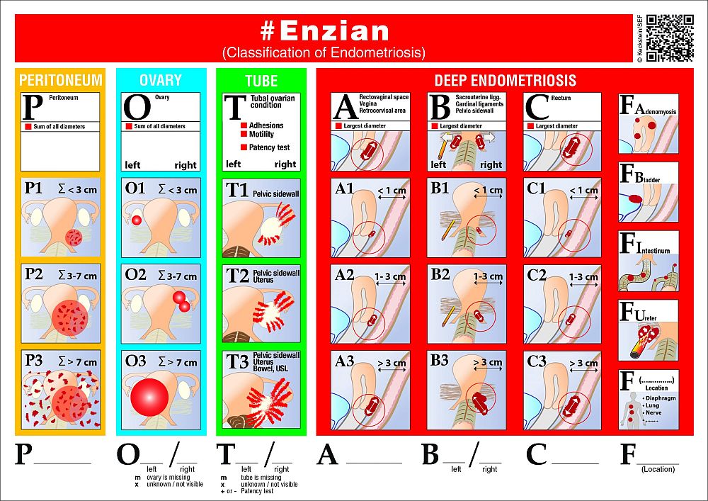 Klassifikation der Endometriose nach #enzian